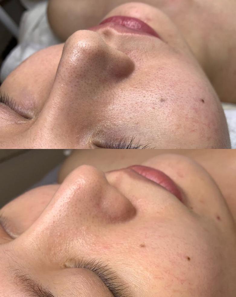 施術前後の比較 - 症例1