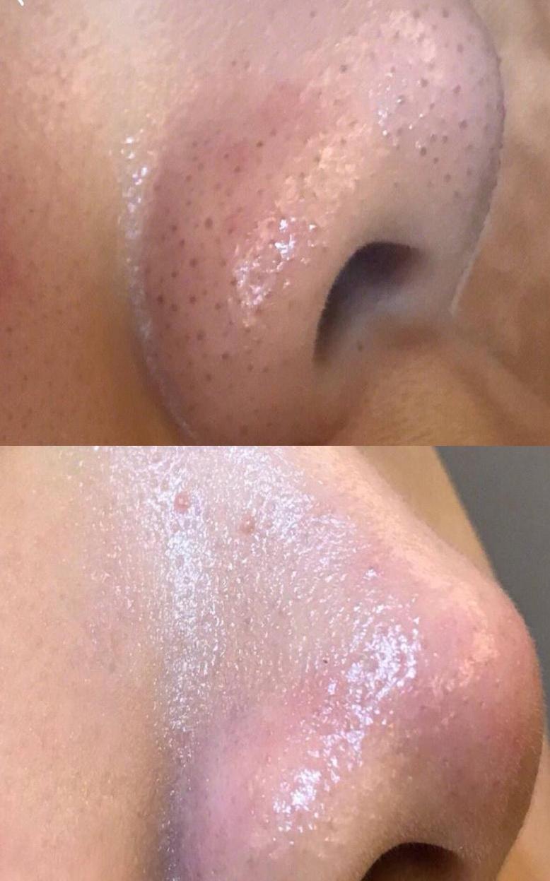 施術前後の比較 - 症例2